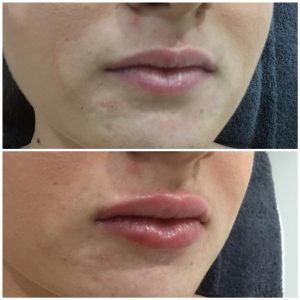Lip Injections - Injex Clinics