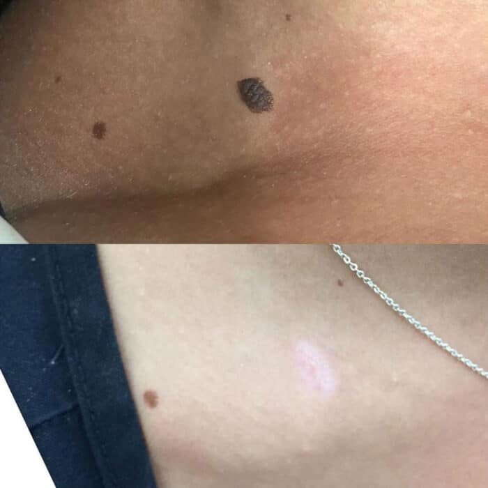 Skin Tag & Mole Removal Brisbane Injex Clinics