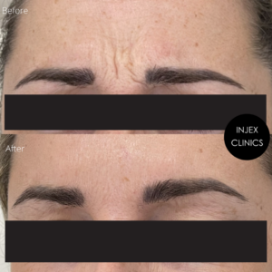 Showcasing the results of 1 session of anti-wrinkle injections in the frown area.