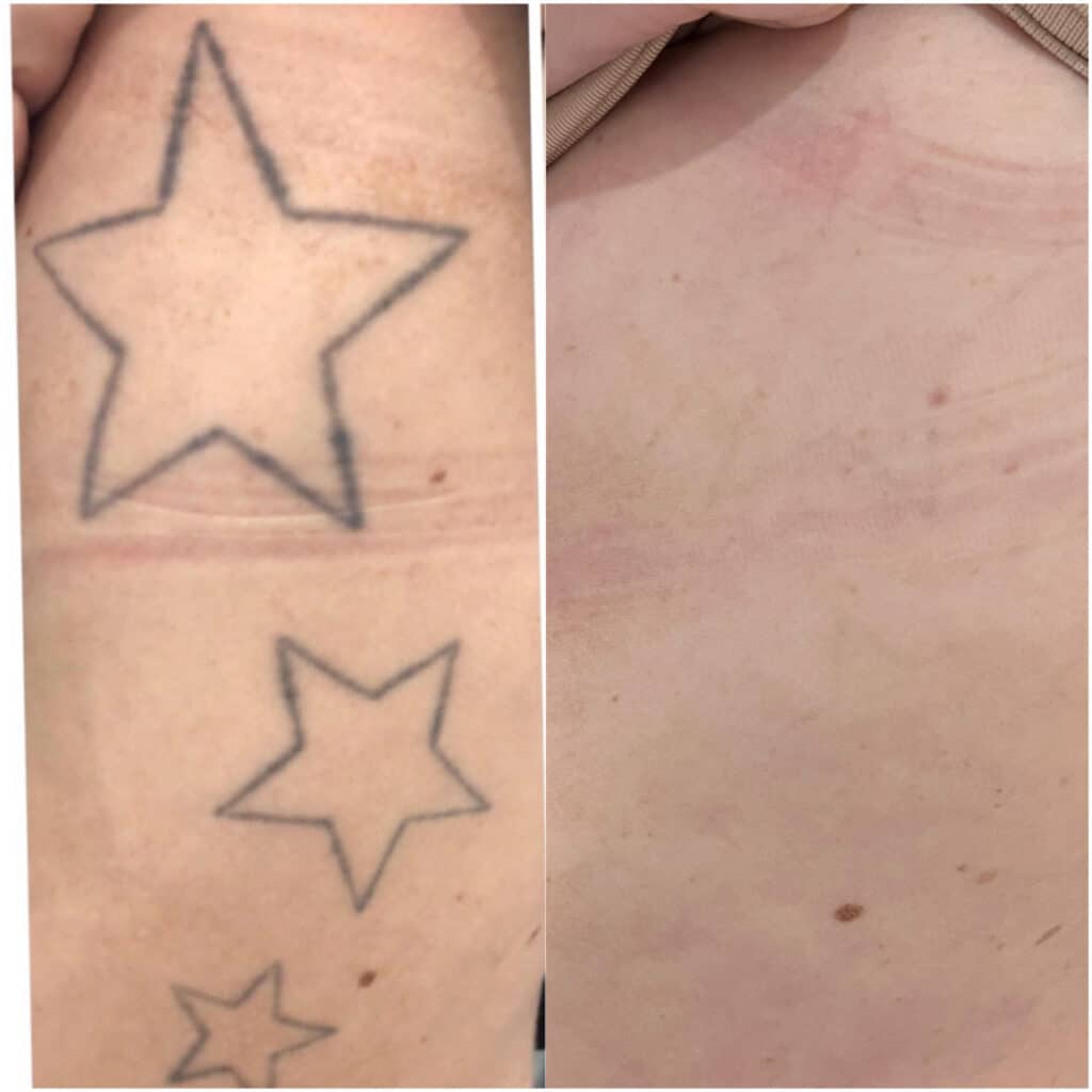 Before and after of tattoo removal, 3 stars