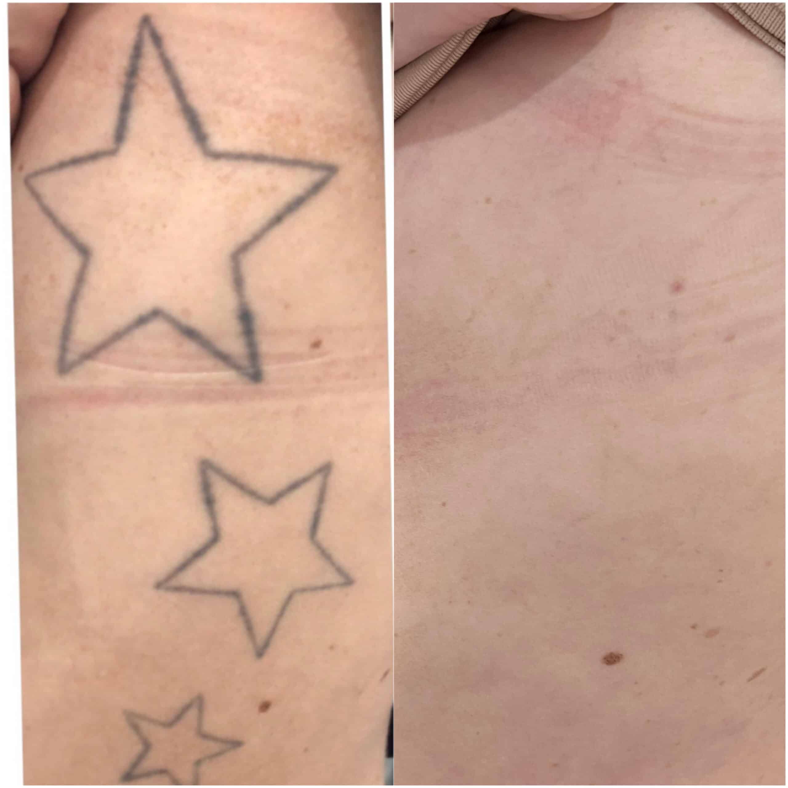 How Does Tattoo Removal Work? - Dermatology Center of Acadiana